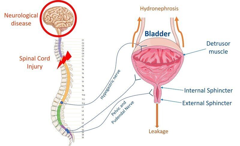neurogenic Bladder